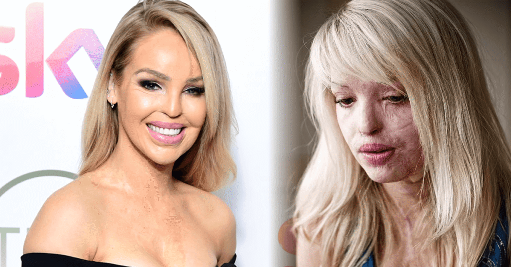 Katie Piper Story